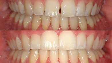 Asthetische Zahnheilkunde Zahnarzt Unterpleichfeld
